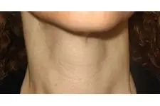 Primer Hipotiroidi Belirtileri Nelerdir?